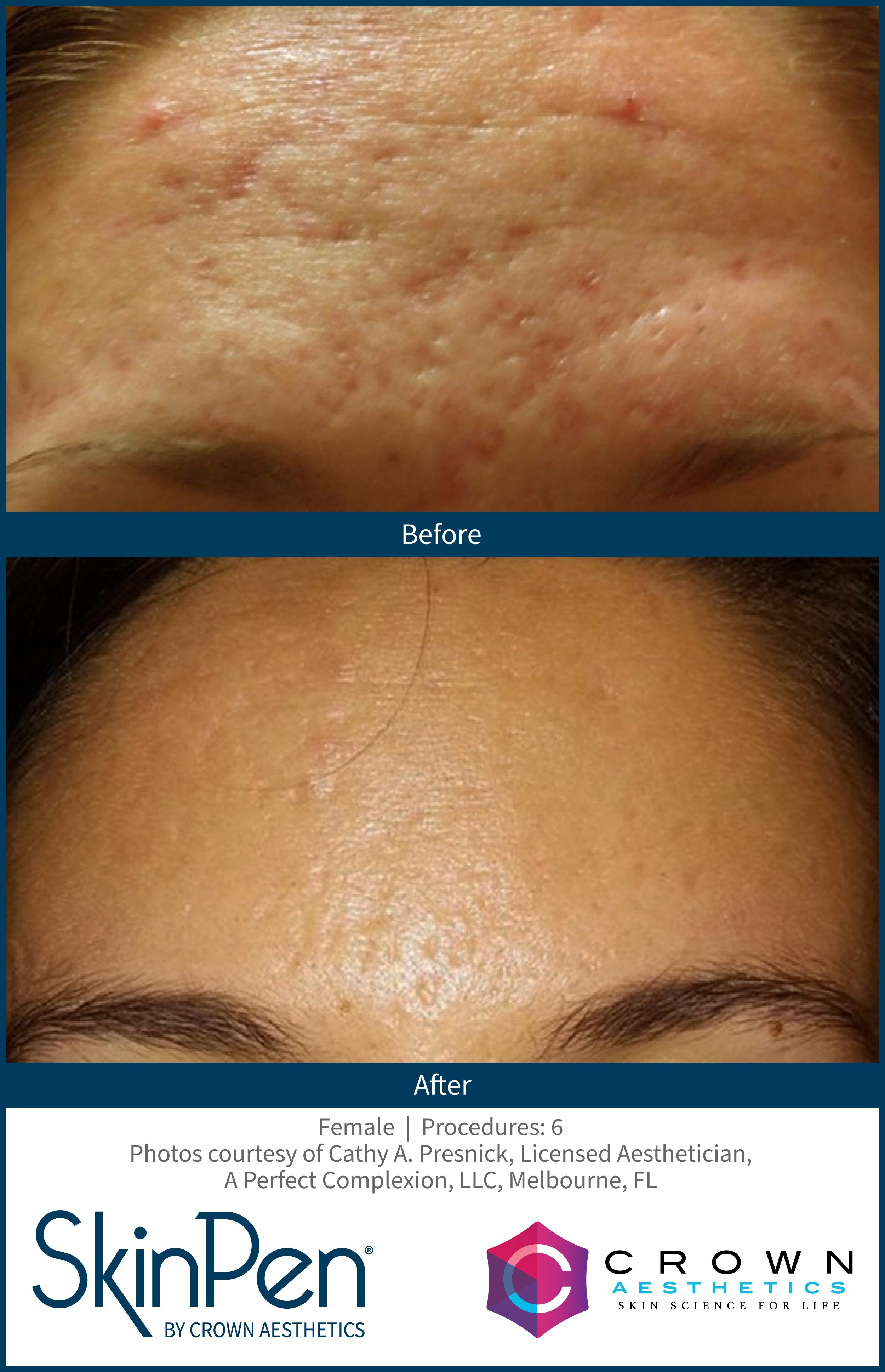 acne scar treatment micro needling before and after
