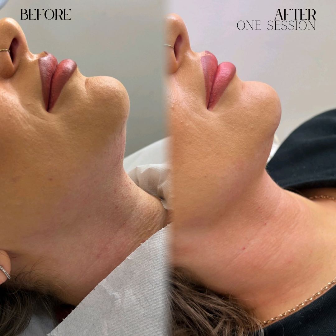 Lemon bottle chin stomach fat dissolving before and after Cockfosters Barnet Southgate Potters Bar